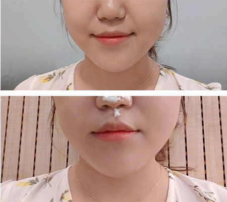 [Арьс] Доттнури - Утасан лифтинг, Шринк