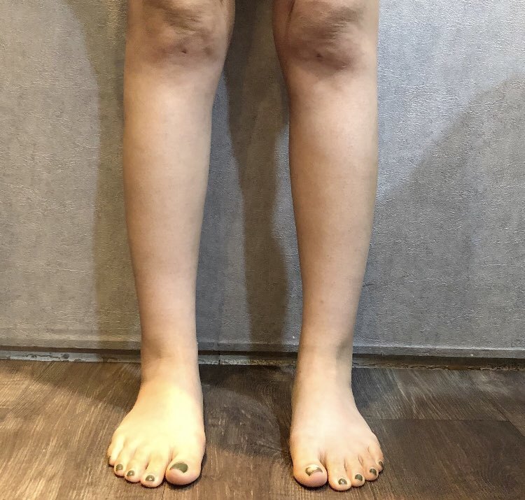 [Өөх соруулах] Од шиг нисээрэй - Гуя, хэвлийн өөх соруулах