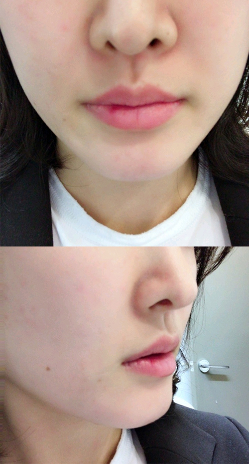 [Бяцхан] Хонг Хонг Додо - Уруулын филлер