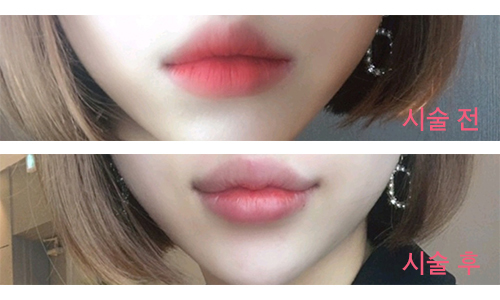 [Бяцхан] Гоё сайхан болох - Уруулын филлер