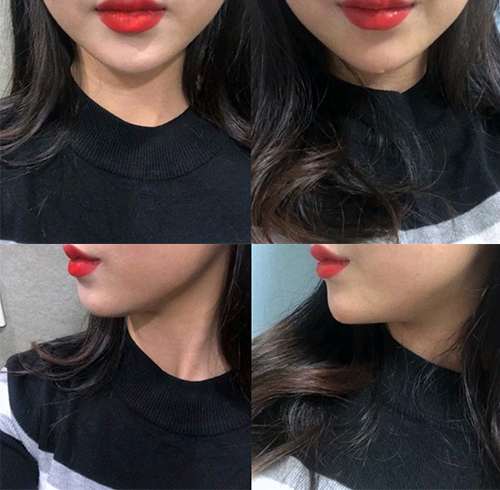 [Жижиг] Ккём-ккён - Эрүүний үзүүрийн филлер, эрүүний булчингийн ботокс