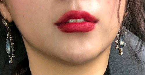 [Жижиг] Ёогуна - Уруулын филлер