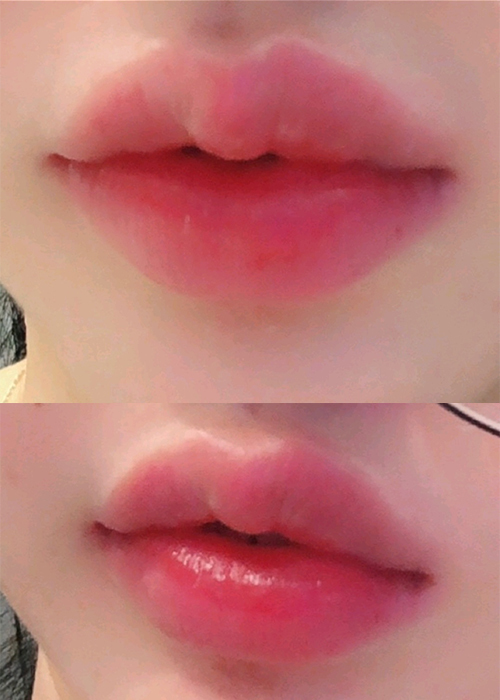 [Бяцхан] ЮнЮнЮнЮнЮнЮн2 - Уруулын филлер