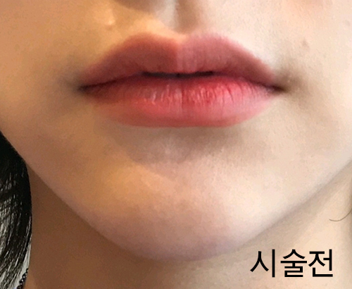 [Бяцхан] Лаллалингдонг - Уруулын филлер