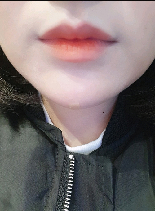 [Бяцхан] kkd0229 - Уруулын филлер