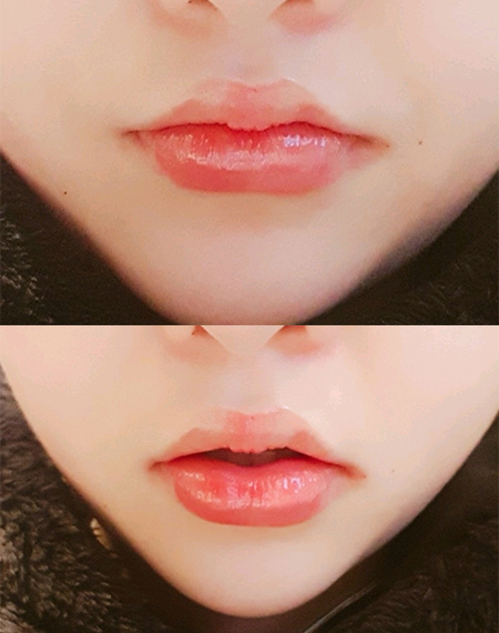 [Жижиг] Ким гүнж, - Уруулын филлер, ботокс