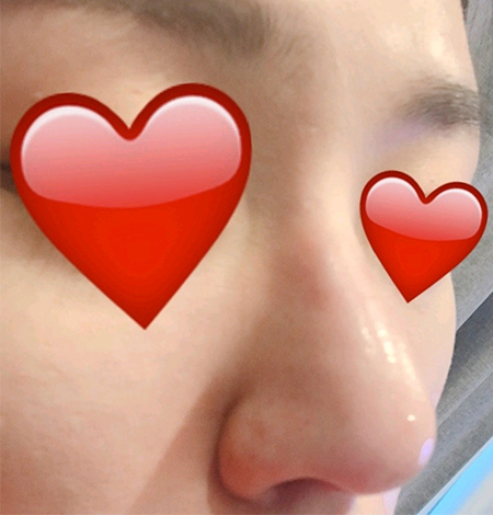 [Жижиг] 2080 Чияаку - Хамрын барималжуулах тариа, Ботокс