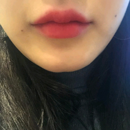 [Бяцхан] hjhsjs - эрүүний ботокс, филлер