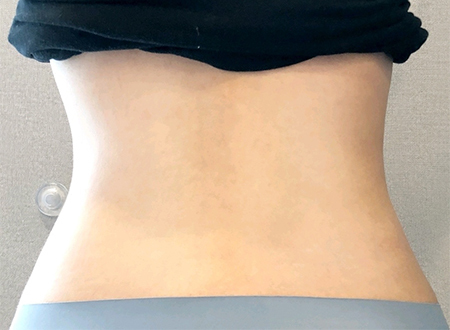 [Өөх соруулах] Ggultabin - Хөл, хэвлийн өөх соруулах