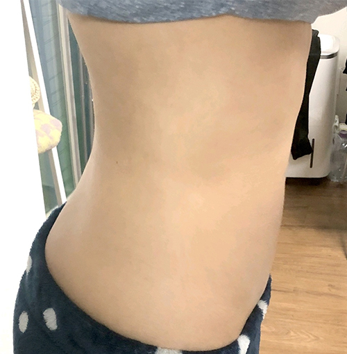 [Өөх соруулах] Одод шиг нисээрэй - Хэвлий, шилбэний өөх соруулах