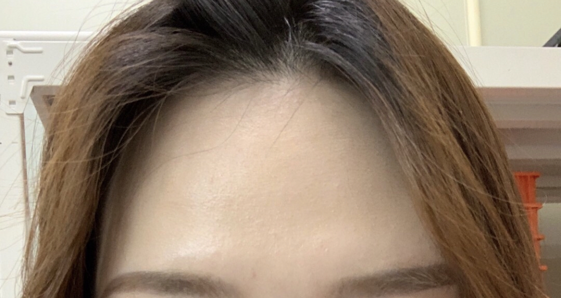 [Анти-Эйджинг] Энэ бол би - Духны өөх шилжүүлэн суулгах