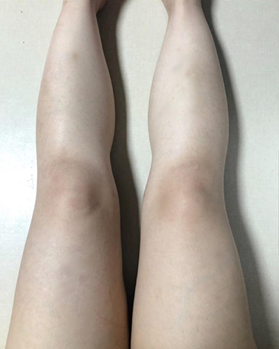 [지방흡입] zz0808 - 종아리,허벅지 지방흡입