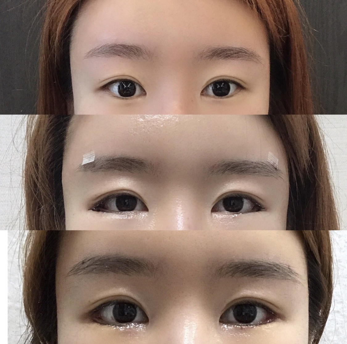 [눈] 나나니난 - 뒤트임, 밑트임