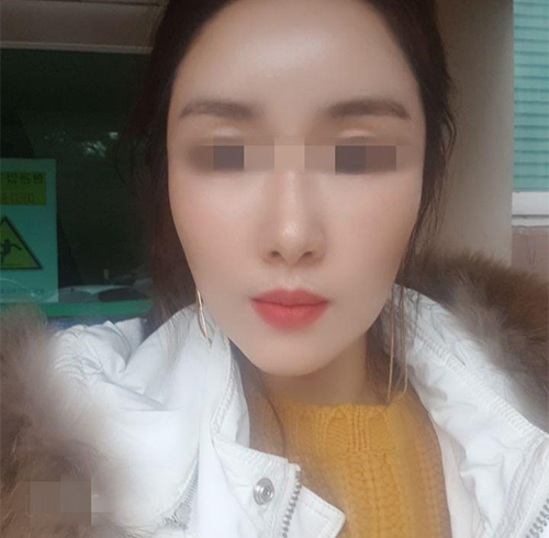 [Chống lão hóa] BinBin House - Cấy mỡ mặt