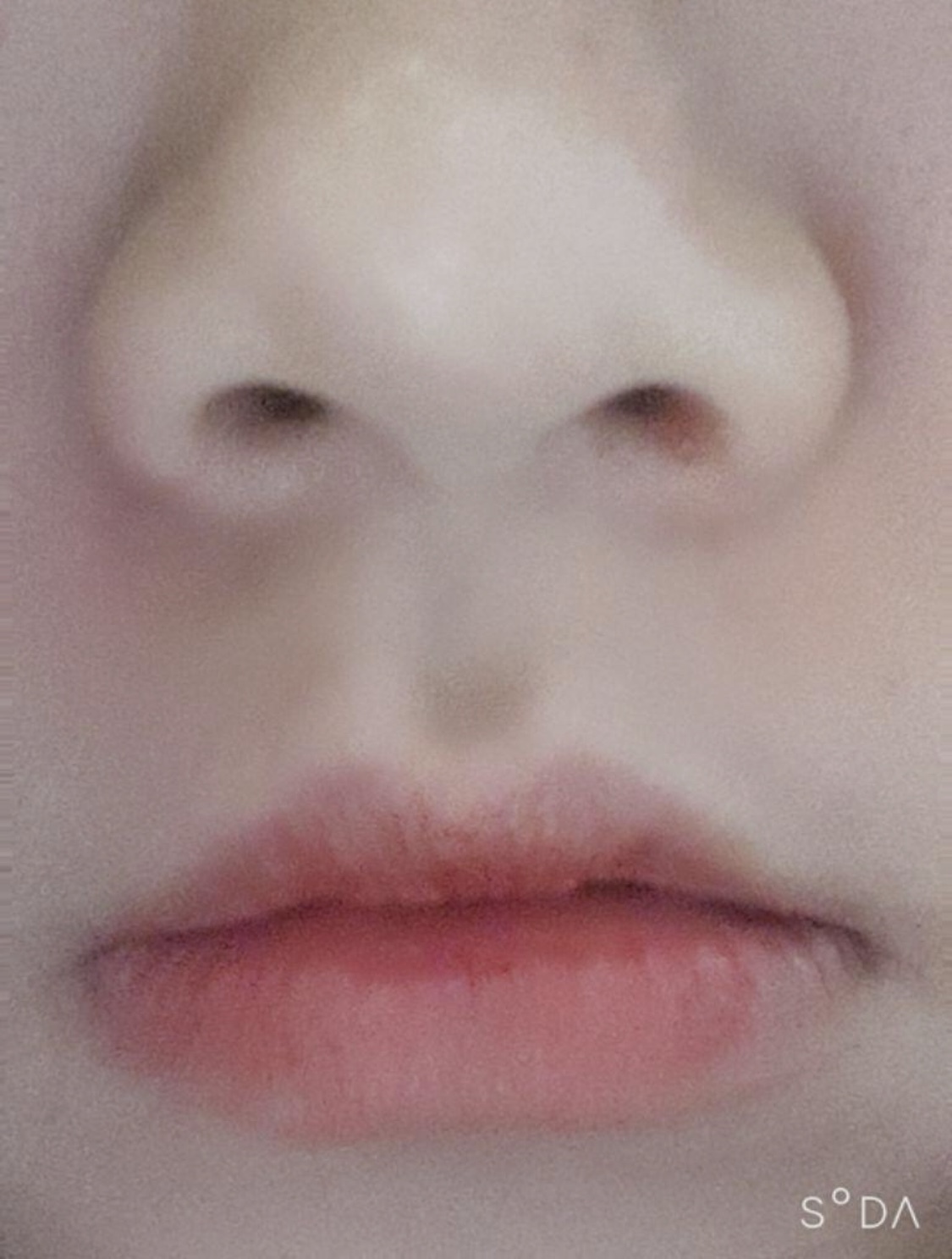 [Tiêm thẩm mỹ] ds0405 - Botox