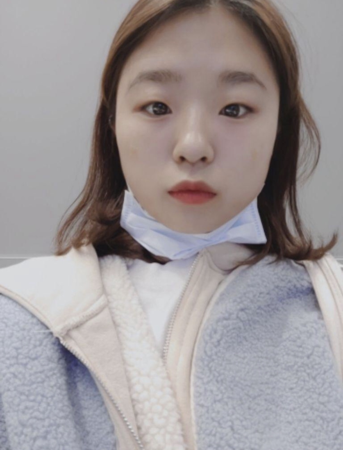 [Tiểu phẫu] Hừm hong hang - Bọng mắt, Botox, Filler