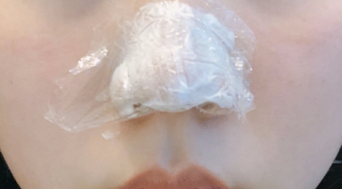 [Tiểu phẫu] Prury - Botox, Đầu mũi