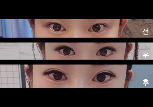 [Mắt] Seobly9999 - Hạ mí, mở rộng góc mắt ngoài