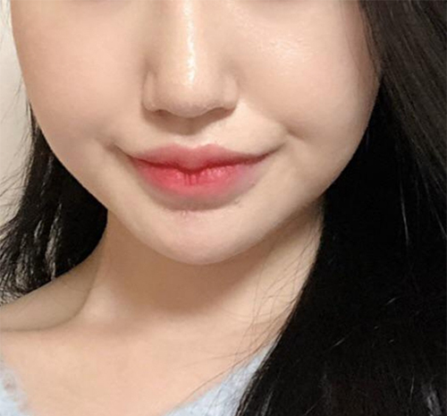 [Da] Zizi Zizi Zizi - Ultherapy, Botox tạo đường nét