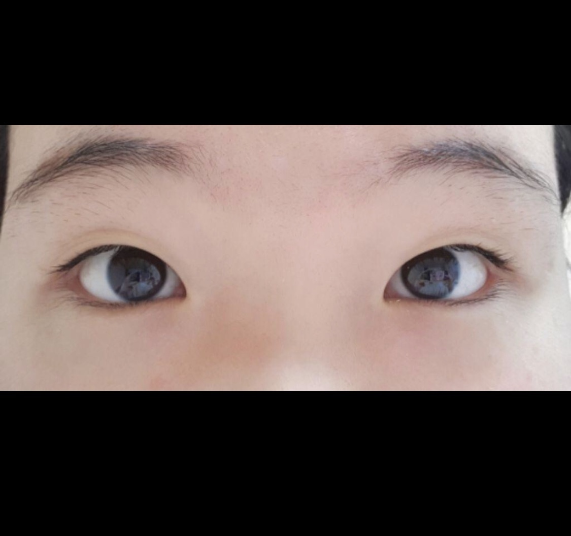 [Mắt] Sseuyun - Bấm mí, mở góc mắt trước