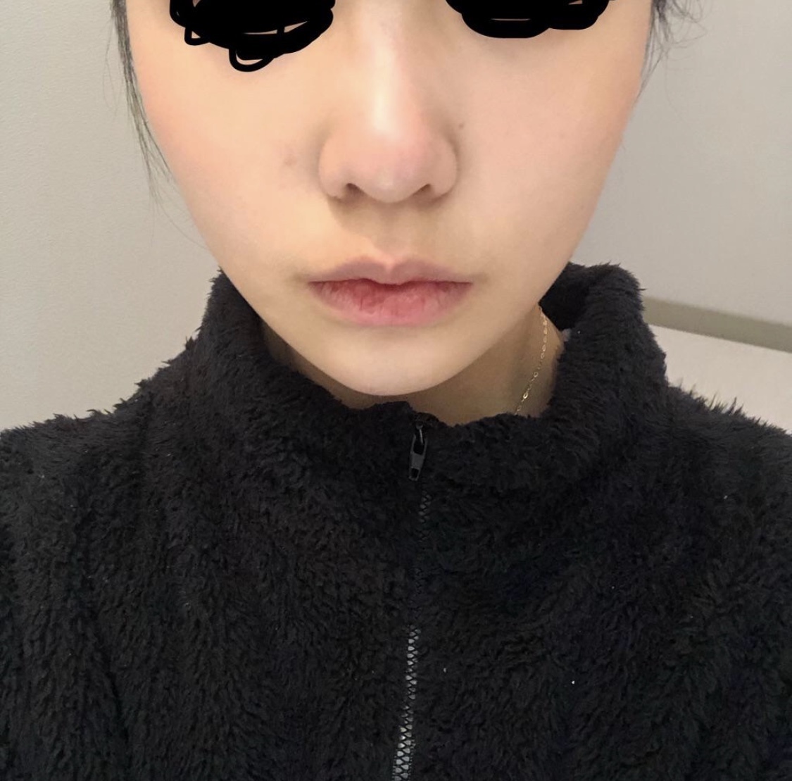 [Mũi] mm9 - Thu gọn cánh mũi