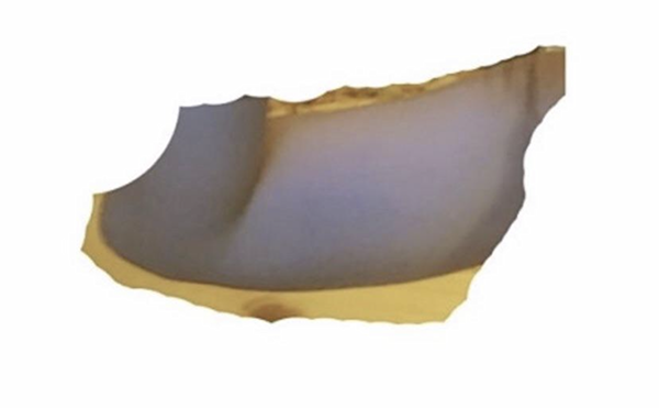 [Hút mỡ] Không có hồi kết - Hút mỡ