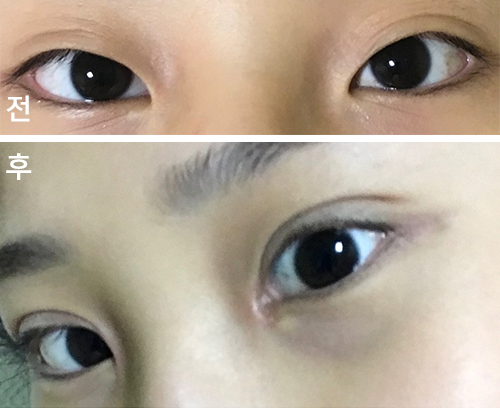 [Mắt] solmdd - Mở góc mắt trong, chỉnh hình mắt