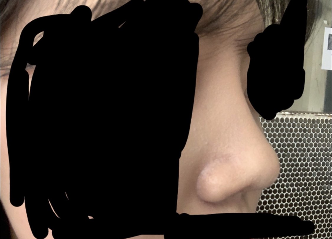 [Mũi] qwert2331 - Mũi