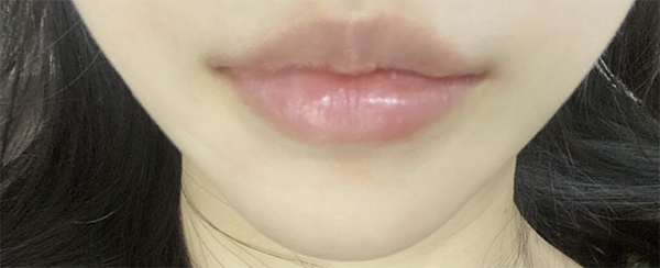 [Tiêm filler] Hí hí hử - Môi