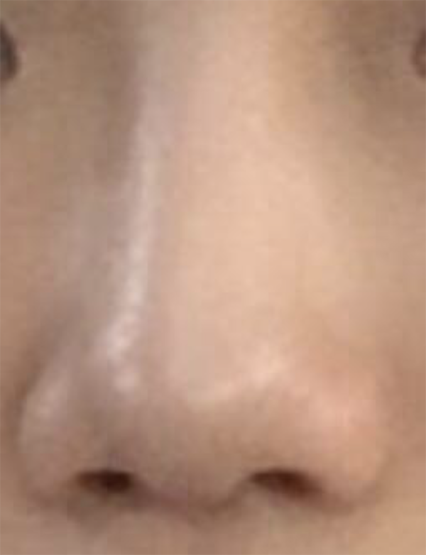 [Tiểu phẫu] dbwladl - Mũi