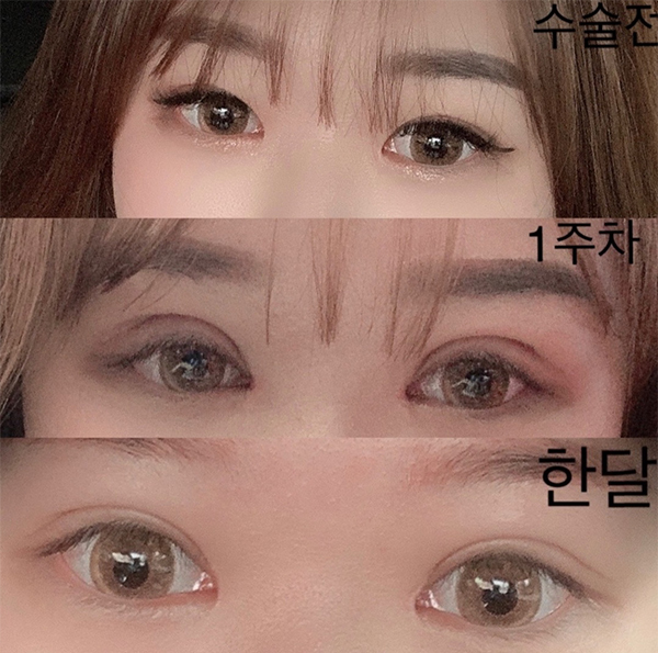 [Mắt] Rohsion - Mở góc mắt trên, chỉnh sửa mắt, tái phẫu thuật