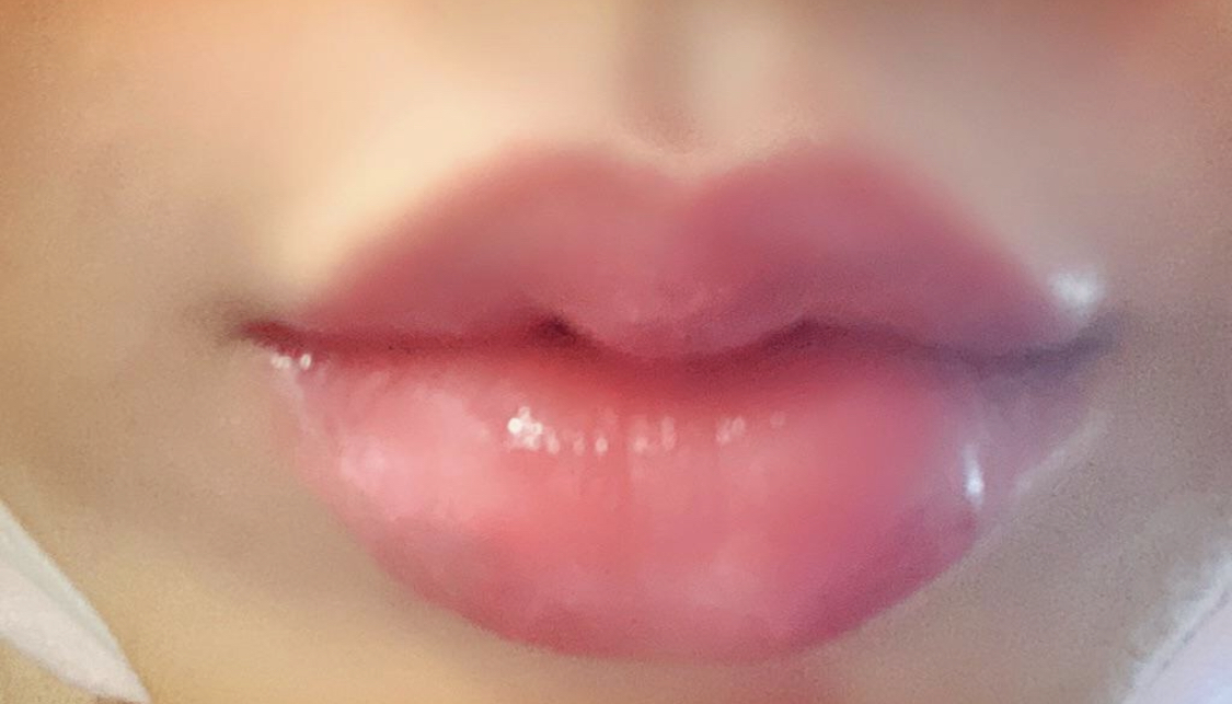 [Tiểu phẫu] Jungdeun2 - Tiêm filler môi