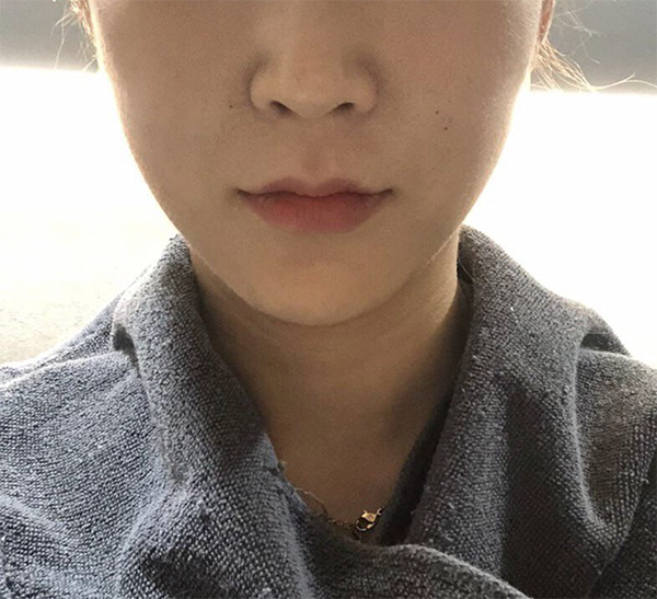 [Da] kkkkyu - Ultherapy