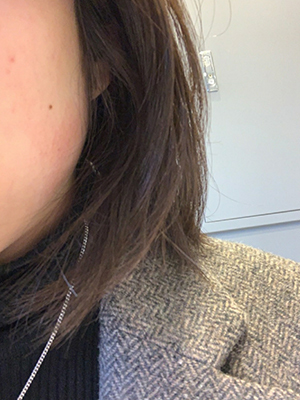 [Tiểu phẫu] Mùa u sầu - Botox cằm