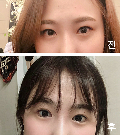 [Mắt] Kyujina - Mở rộng góc mắt ngoài, Hạ góc mắt