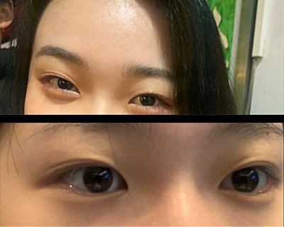 [Mắt] Jihae 1 - Bấm mí, chỉnh hình mắt