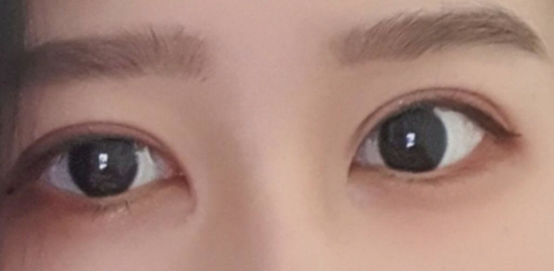 [Mắt] Mừng - Mở góc mắt trong, Tái phẫu thuật mắt