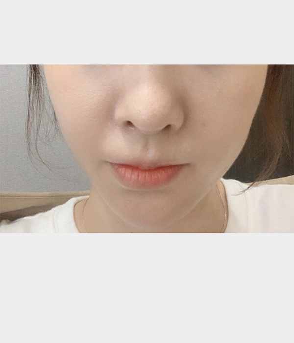 [微整] 55針 - 埋線拉提