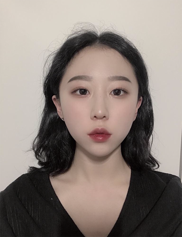 [微整形] 夜晚的芒果冰沙 - 肉毒桿菌、玻尿酸填充