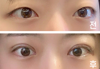 [Нүд] Дээвэрs2 - Дээд зүсэлт, Нүдний хэлбэр засах