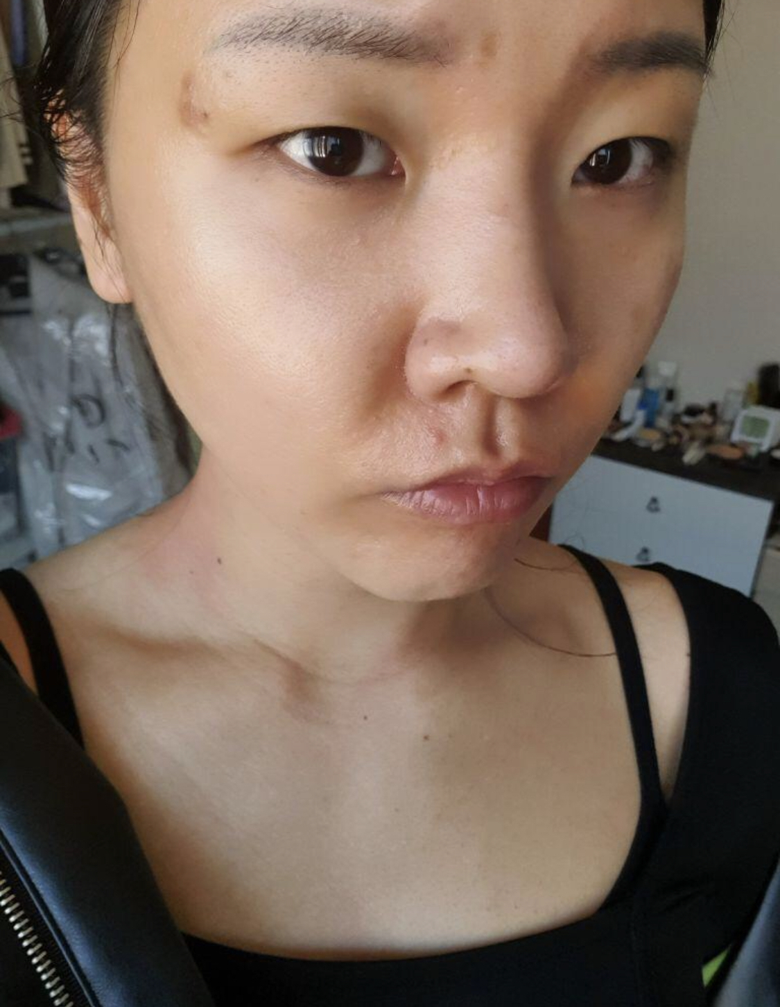 [Mắt] Binnabitna - Cắt mí, Mở góc mắt