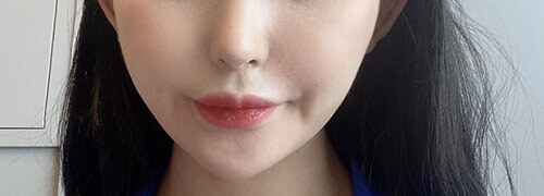 [Da đẹp] DaGyoungDaGyoung - Ulthera, Airjet