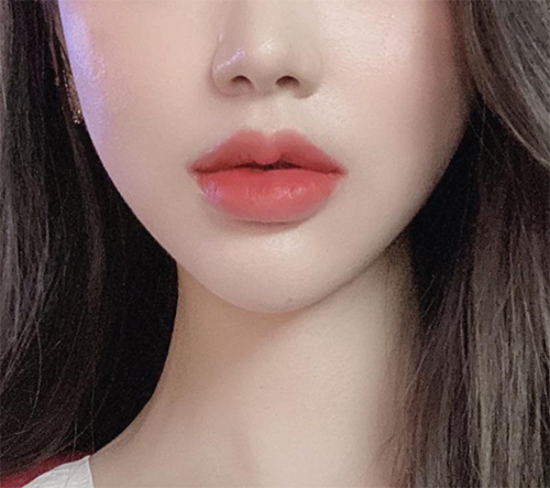 [Жижиг] Сэёолин - Хамрын үзүүрийн ботокс