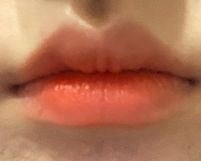 [Tiểu phẫu] Rapunzel@ - Tiêm filler môi