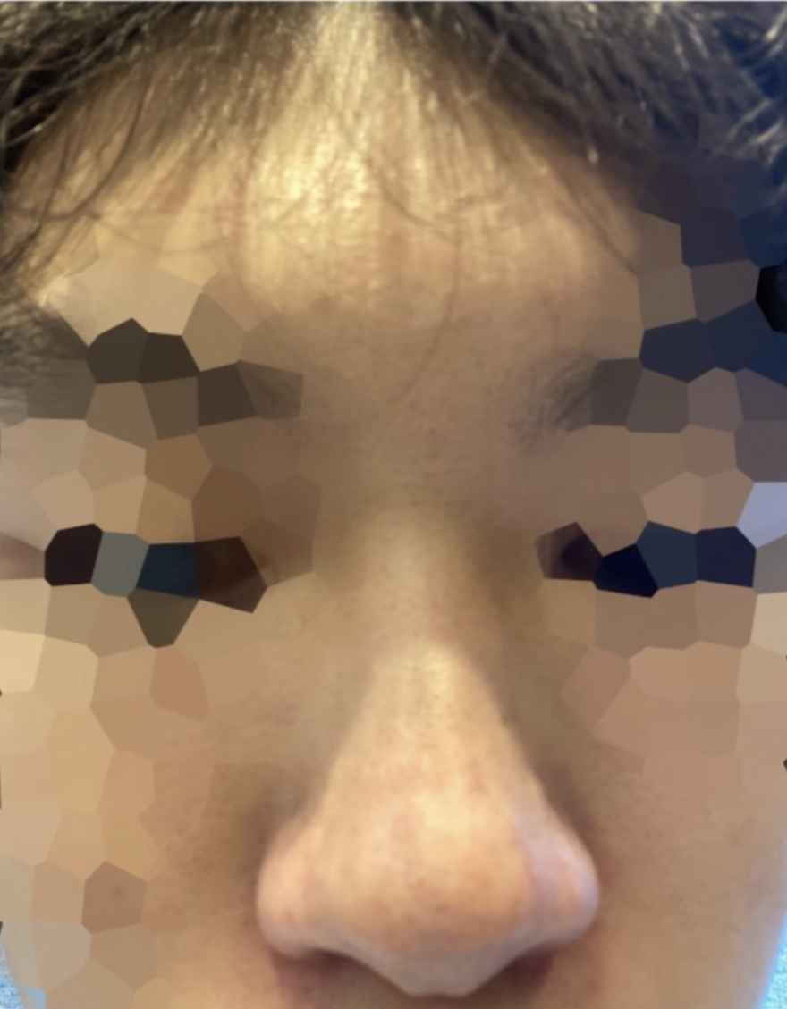 [Mũi] dlspsl - Mũi