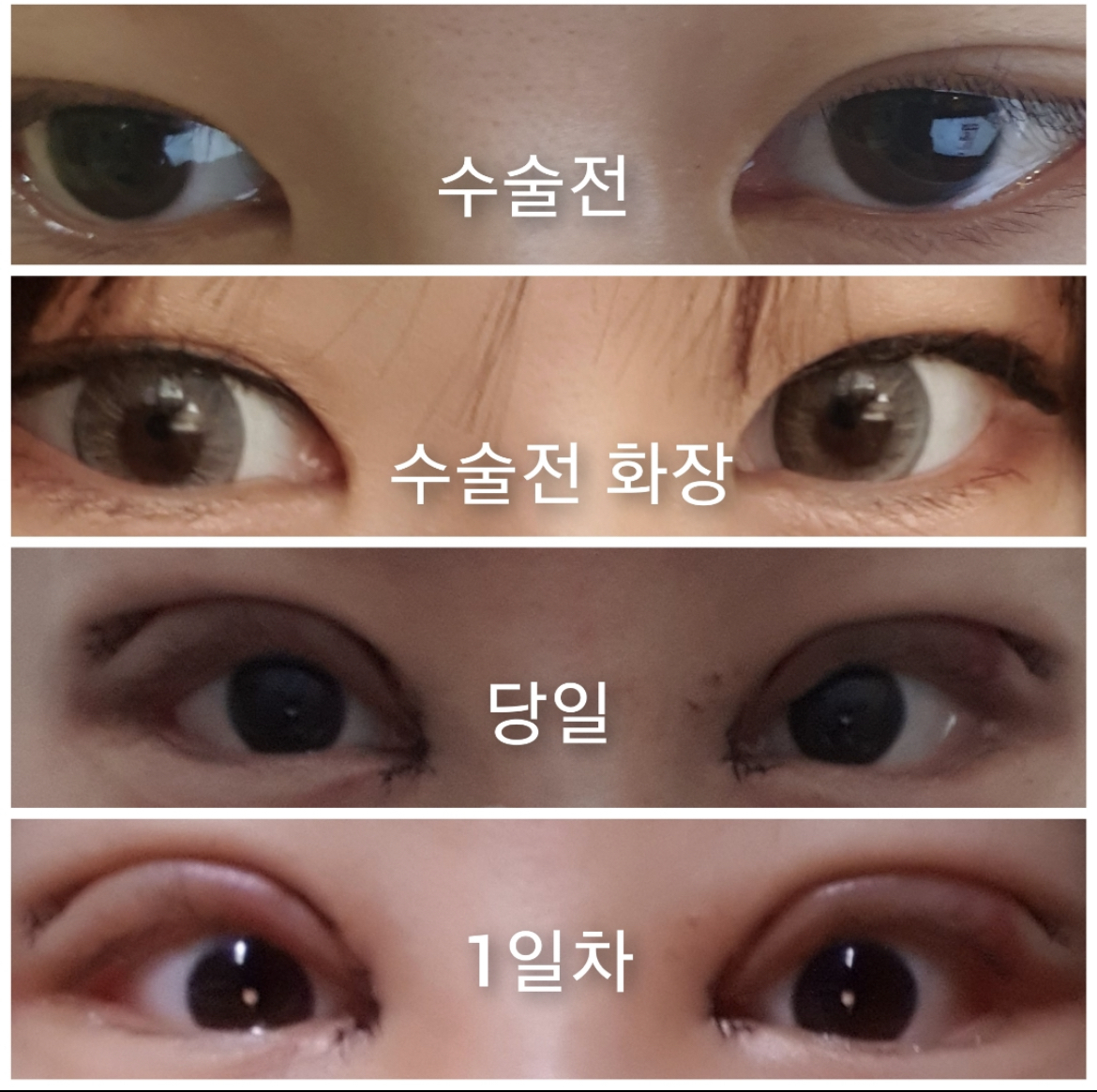 [Нүд] Гогиён - Давхар зовхи, дээд зовхины өргөлт, доод зовхины өргөлт