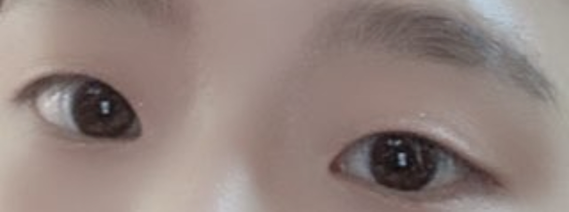 [Mắt] LeeSoo - Bấm mí, mở góc mắt trước