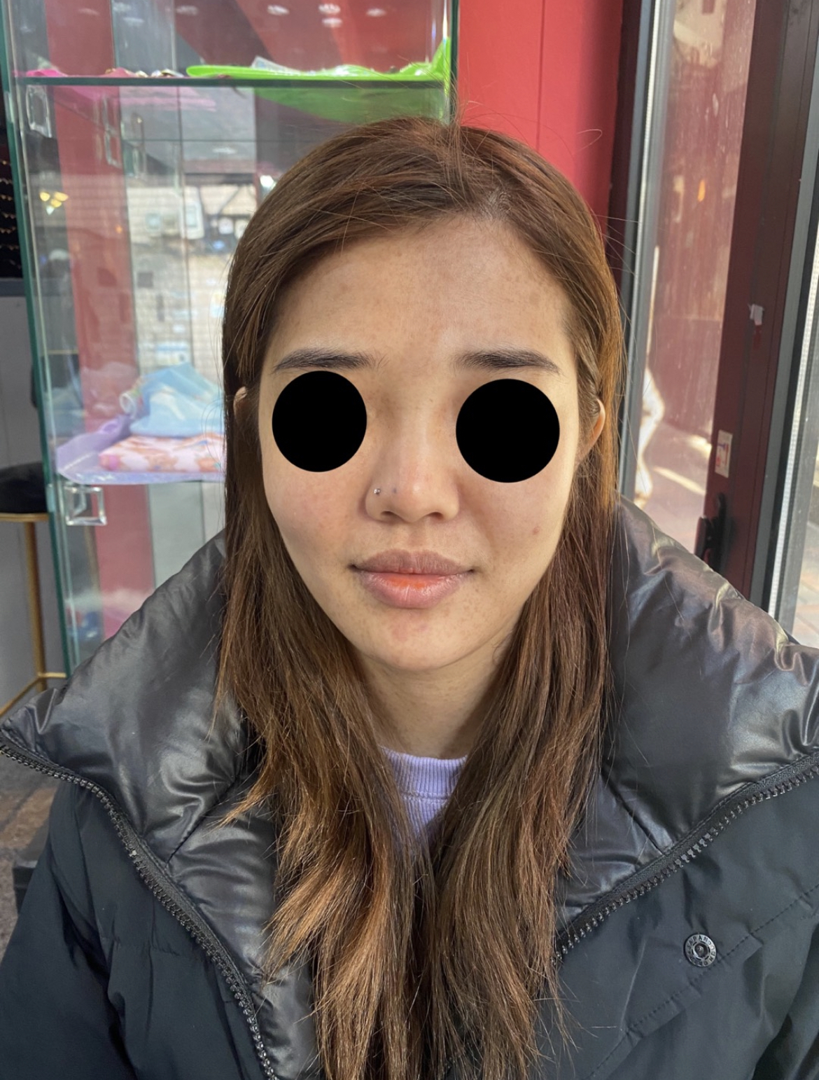 [Chống lão hóa] ppkim0119 - Cấy mỡ