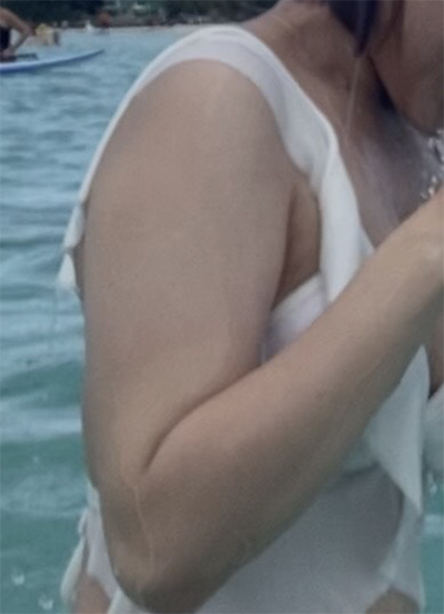 [지방흡입] 서옒 - 팔