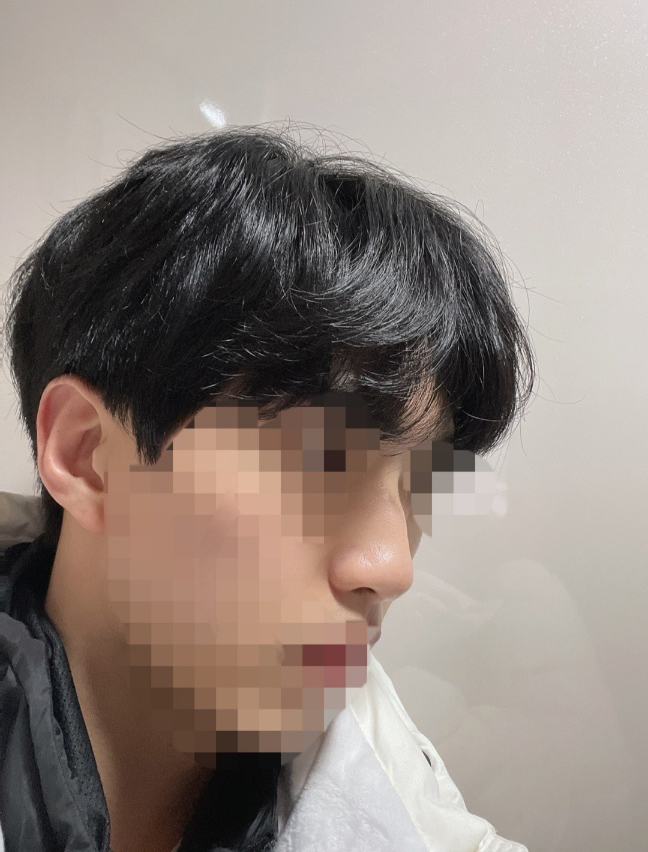 [코] 민야야 - 코(실리콘, 비중격연골)